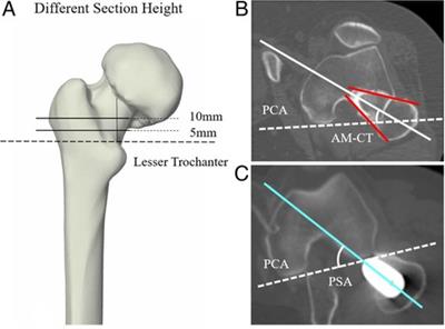 The midcortical-line is more reliable than the T-line in predicting stem anteversion in patients with developmental hip dysplasia after total hip arthroplasty